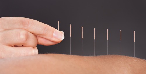 Acupuntura Acupuntura
