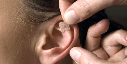 Auricoloterapia Auricoloterapia