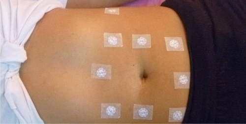 Stiperterapia Stiperterapia